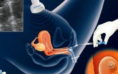 死精率80%的男性可以在张掖市做三代试管吗？公开2026做三代试管条件